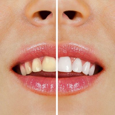 teeth-whitening-port-macquarie